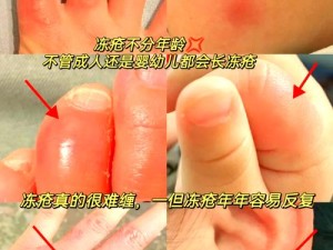 第九所游戏中遇到冻伤怎么办？全面冻伤解决攻略大揭秘！