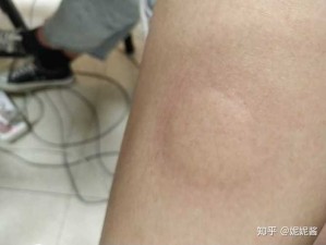 阿明被蚊咬双包，资源管理视角下的应对与启示