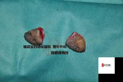 小阴天唇肥大整形是否真有必要探讨