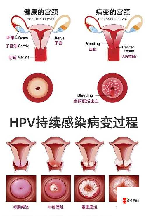 HPV 感染与性接触关系之全面解析