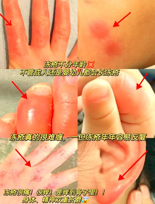 第九所冻伤怎么解决？冻伤解决攻略分享